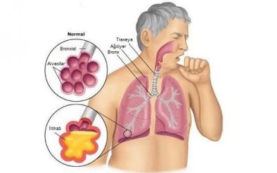 Ağciyər Iltihabları