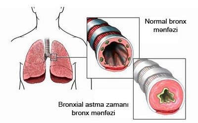 Bronxial Astma Xesteliyi