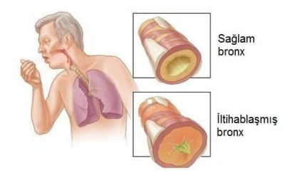 Kəskin Və Xroniki Bronxit