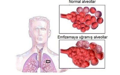Emfizema - Ağciyər Emfizeması