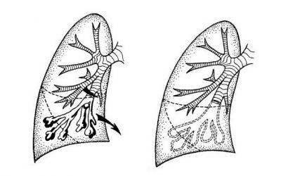 Bronxoektaziya Xesteliyi