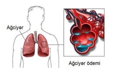 Ağciyər ödemi